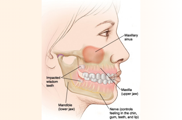 Illustration of an impacted wisdom tooth, explaining what are wisdom teeth and why they get stuck
