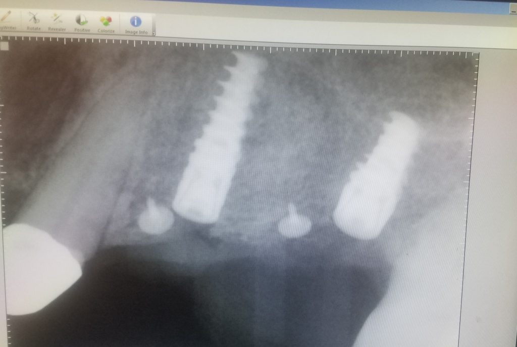  x-ray