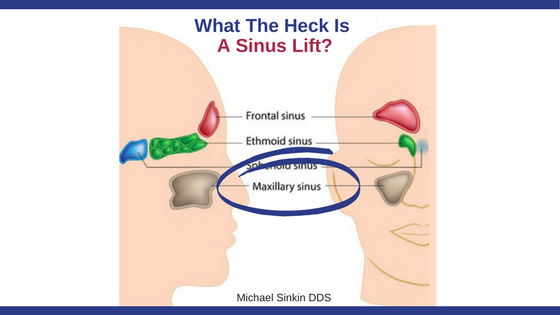 What The Heck Is A Sinus Lift