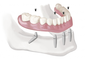 What Are Dental Mini Implants