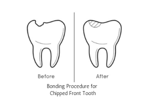bonding for chipped front tooth, michael sinkin dds, nyc dentist