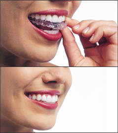 Invisalign Invisible Removable NYC Sinkin