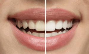 Before-and-after teeth whitening comparison