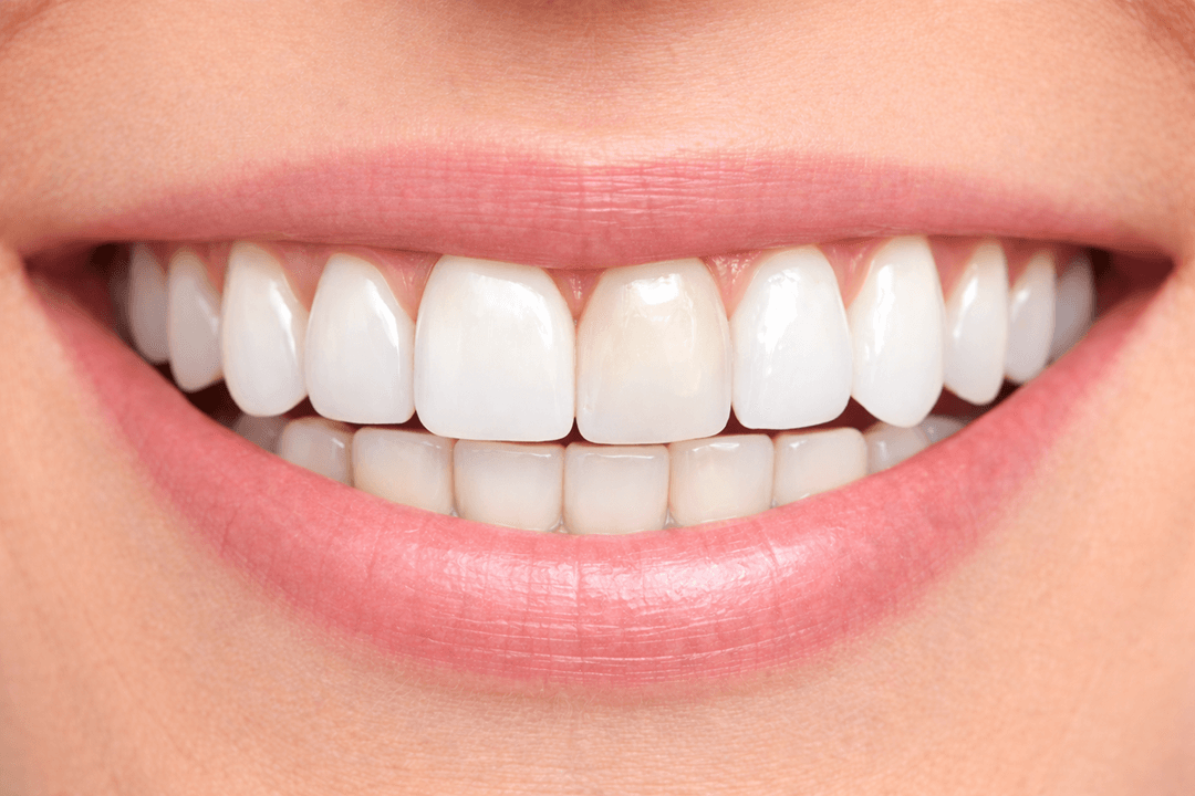 Smile after whitening showing natural teeth lighter than implant crown.