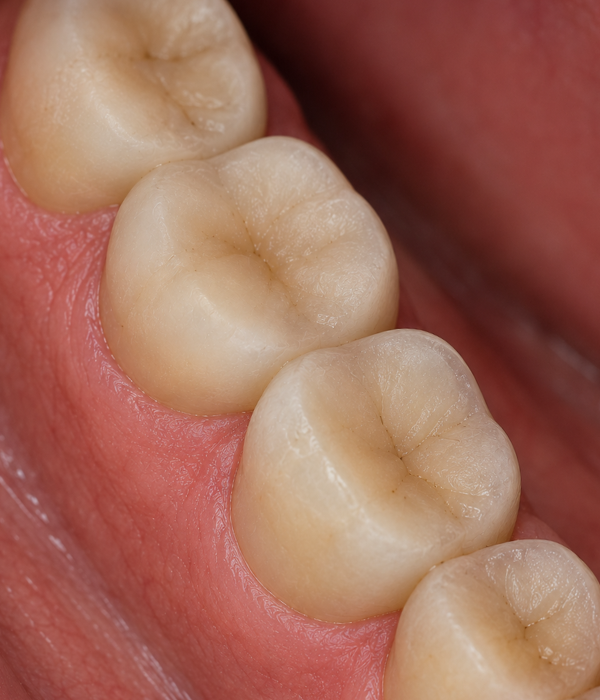 Ceramic dental crown on a natural tooth