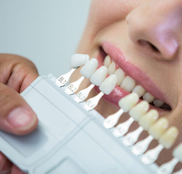 Dentist performing in-office teeth whitening treatment on a patient in Manhattan
