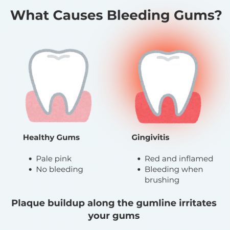 Healthy Gums vs gingivitis